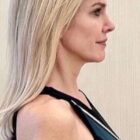 Profile of a woman after the Emface Treatment in South Jordan, UT