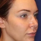 Woman after the Emface Treatment in South Jordan, UT